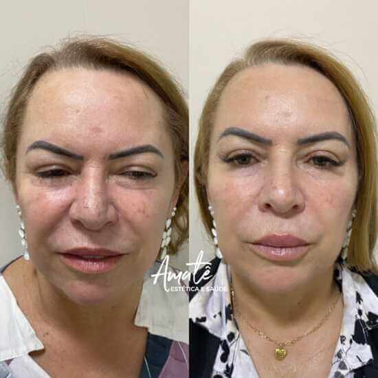 Amatê Morumbi e São Caetano - Harmonização Facial e Corporal - Endosculpt