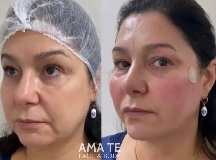 Amatê Morumbi - Harmonização Facial e Corporal - Bioestimulador