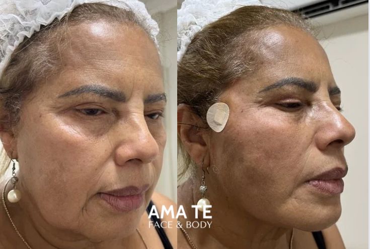 Amatê Morumbi - Harmonização Facial e Corporal - Fios de Garra