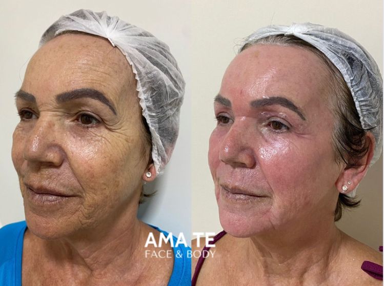 Amatê Morumbi - Harmonização Facial e Corporal - Peeling Ambar