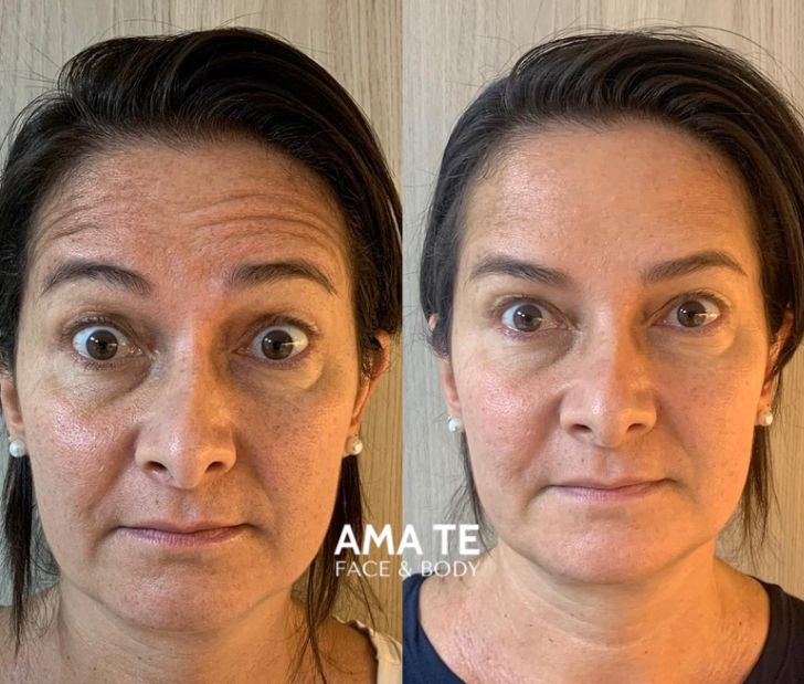 Amatê Morumbi - Harmonização Facial e Corporal - Toxina Botulinica